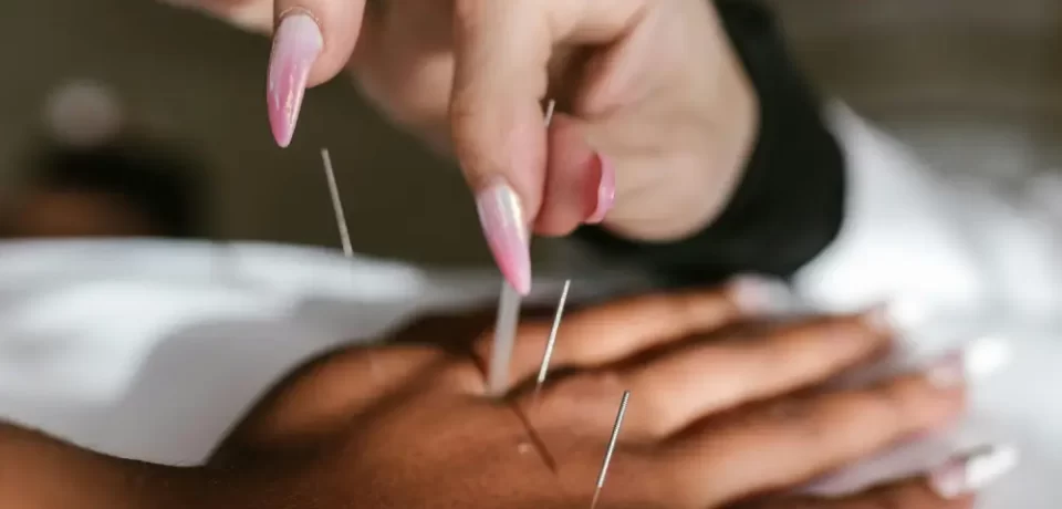 Técnica de acupuntura en la mano, mostrando una aguja siendo insertada por una profesional con uñas largas y decoradas. La imagen resalta la terapia alternativa y el bienestar.